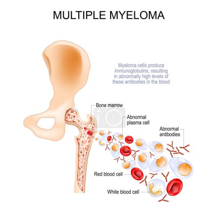 Illustration for Multiple myeloma. Cross section of a Bones of the hip joint, Pelvis and femur. flow with Normal leukocytes and Red blood cells, Abnormal antibodies and plasma cells. Vector poster - Royalty Free Image