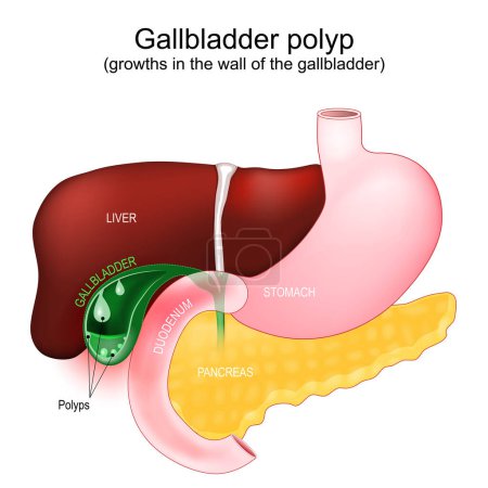 Téléchargez les illustrations : Cross section of a Gallbladder with polyps. Abnormal accumulations of mucous membrane tissue, growths in the wall of the gallbladder. Part of a human gastrointestinal tract with liver, duodenum, pancreas and stomach. Vector poster - en licence libre de droit