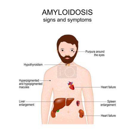 Téléchargez les illustrations : Amyloidosis. Signs and symptoms. Human body with Purpura around the eyes, skin rash, liver, kidneys, thyroid gland, heart and spleen. Vector poster - en licence libre de droit