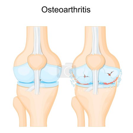 Ilustración de Knee osteoarthritis. degenerative joint disease. Cartilage becomes worn. Vector poster - Imagen libre de derechos
