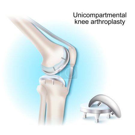 Téléchargez les illustrations : Unicompartmental knee arthroplasty. surgical procedure for treatment or relieve arthritis, after joint damaged. uni knee implant. Partial knee replacement on blue and white background. side view of human joint. Vector illustration - en licence libre de droit