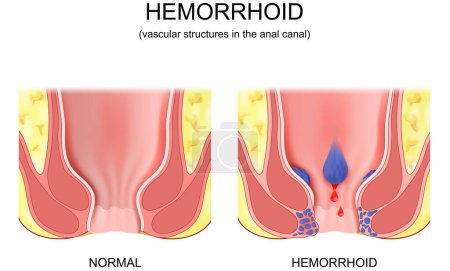 Ilustración de Piles. hemorrhoidal disease. comparison and differences between healthy rectum and part of a large intestine with internal and external hemorrhoids, Pectinate line and Rectal bleeding. Cross section of the rectum and anal canal. Vector poster - Imagen libre de derechos