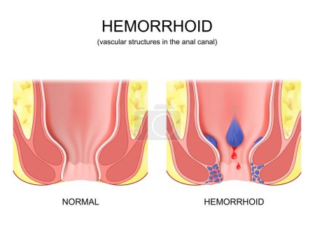 piles. hemorrhoidal disease. comparison and differences between healthy rectum and part of a large intestine with internal and external hemorrhoids, Pectinate line and Rectal bleeding. Cross section of the rectum and anal canal. Vector poster