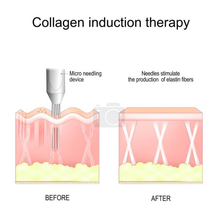 Collagen induction therapy. microneedling. skin needling procedure for remove wrinkles, scars, stretch, marks, pigmentation. repeatedly puncturing the skin with tiny sterile needle. Vector poster