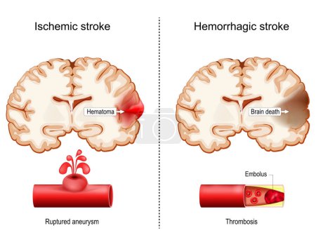 Téléchargez les illustrations : Hemorrhagic and Ischemic strokes. Cross sections of human brain with Hematoma and part of Brain death.  close-up of blood vessel with Ruptured aneurysm and cut of artery with Embolus. Thrombosis. Vector poster - en licence libre de droit