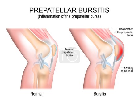 Prepatellar bursitis. inflammation of the prepatellar bursa. comparison of a human knee with Normal prepatellar bursa, and joint with Bursitis. vector poster