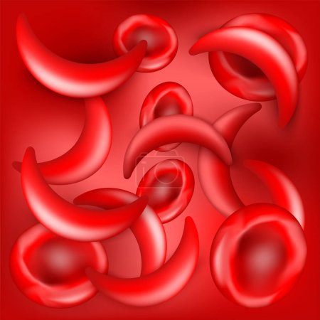 Sickle cell disease. SCD. Normal erythrocytes and sickle cells on blood flow. red background. Anemia or anaemia. blood disorders. Vector poster