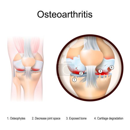 Illustration for Osteoarthritis. Human leg with inflammation of knee. Close-up of knee joint with  arthritis symptoms: Cartilage degradation, Exposed bone, Decrease joint space, and Osteophytes. Vector illustration - Royalty Free Image