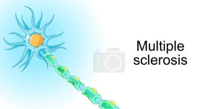 Illustration for Multiple sclerosis. demyelinating disease. autoimmune disease. Vector illustration for poster or banner about World Multiple Sclerosis Day. - Royalty Free Image