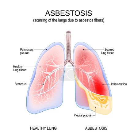 asbestose des poumons. Inflammation et cicatrisation des poumons due aux fibres d'amiante. cancer. Illustration vectorielle