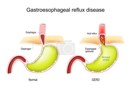 Gastroösophageale Refluxkrankheit. GERD. Querschnitt durch den menschlichen Magen. Normales internes Organ und Magen mit saurem Reflux. Vektorillustration