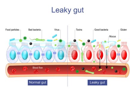 Leaky-Darm-Syndrom. Unterschied zwischen gesunden Zellen und entzündeten Darmzellen. Vergleichen Sie normales Gewebe des Magen-Darm-Traktes und die Durchlässigkeit des Darms. Die Darmbarriere funktioniert nicht. Darmentzündung. Vektorplakat