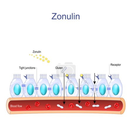 Zonulin ist ein Protein, das die Durchlässigkeit der engen Verbindungen zwischen Zellen der Wand des Magen-Darm-Traktes erhöht. Verdauungssystem. Darmzellen mit Zonulin-Rezeptoren, normalen und fehlerhaften Tight Junctions. Durchlässigkeit des Darms. Gu