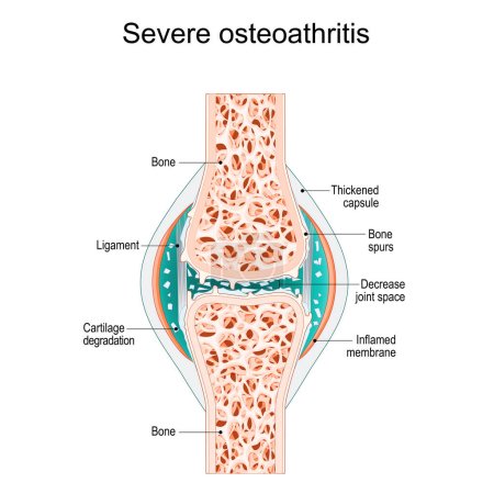 Illustration for Severe osteoarthritis. Synovial joint with bone Spurs, Inflamed membrane, Decreased joint space, and Cartilage degradation. vector illustration - Royalty Free Image