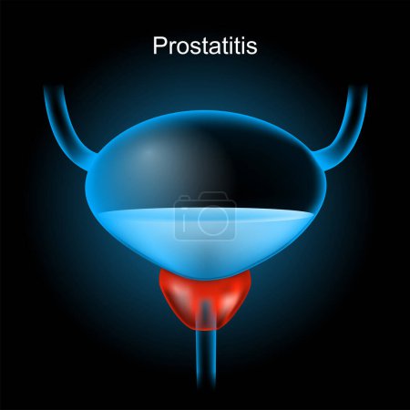 Prostatitis. Red Prostate gland and blue realistic bladder with glowing effect on dark background. Human urinary system. Part of male reproductive system. vector illustration like x-ray image. 