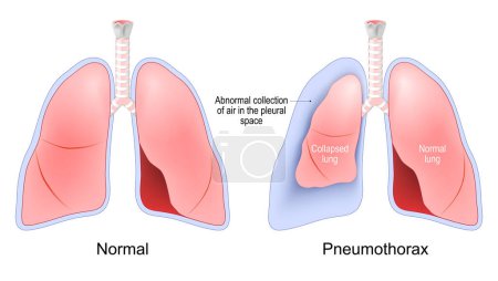 Ilustración de Neumotórax. acumulación de aire entre el pulmón y la cavidad torácica. Pulmones normales y colapsados. Sistema respiratorio humano. Ilustración vectorial - Imagen libre de derechos