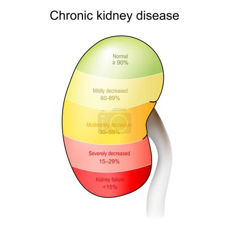 Chronic kidney disease. Stage of disease from Normal and Mildly decreased, to Kidney failure. eGFR test result and how kidneys to filter of blood. vector illustratio