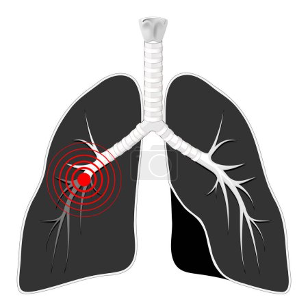 Téléchargez les illustrations : Maladie pulmonaire. Poumons noirs avec bronches et marque rouge sur fond blanc. Appareil respiratoire humain. Illustration vectorielle - en licence libre de droit