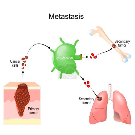 Metástasis. Las células cancerosas del tumor primario sobreviven en los ganglios linfáticos y se diseminan a otros órganos. invasión de cáncer. tumor maligno. ilustración vectorial