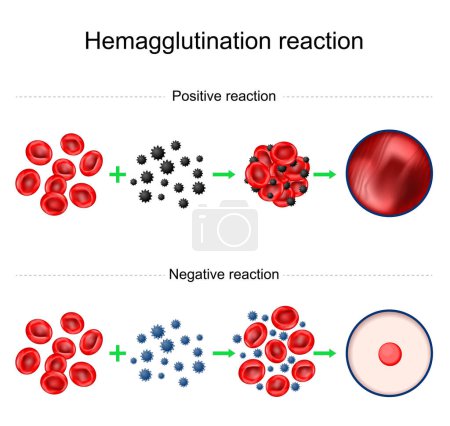 Illustration for Hemagglutination reaction. Blood typing. Negative and Positive reaction. Agglutination test. laboratory technique used to determine the presence of antibodies or antigens by observing ability to clump together of red blood cells. Vector poster - Royalty Free Image