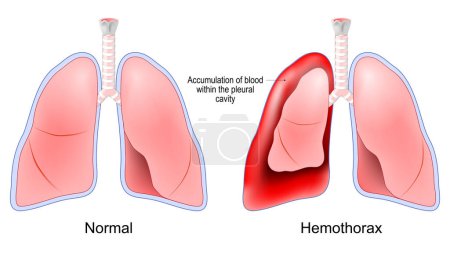 Illustration for Hemothorax. Healthy human lungs and red lungs after accumulation of blood within the pleural cavity. Chest trauma. pulmonary embolism treatment. Vector poster - Royalty Free Image