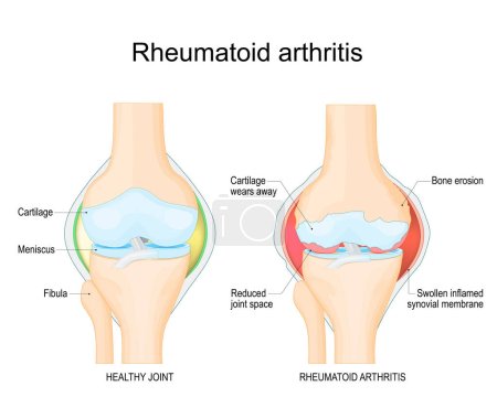 Rheumatoide Arthritis. Ein Vergleich zwischen einem gesunden Knie- und Gelenk mit Knochenerosion, Knorpelverschleiß, verringertem Gelenkraum und geschwollener entzündeter Gelenkinnenhaut. Vektorillustration mit Beschriftungen. Diagnosebilder zur Unterstützung von Patient und Arzt