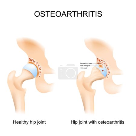 Articulación de cadera con osteoartritis con cabeza femoral y acetábulo de la pelvis. Una comparación entre una articulación de cadera sana y una con osteoartritis, destacando las diferencias clave en la estructura. Esto puede ayudar a los pacientes a entender el diagnóstico. Vector