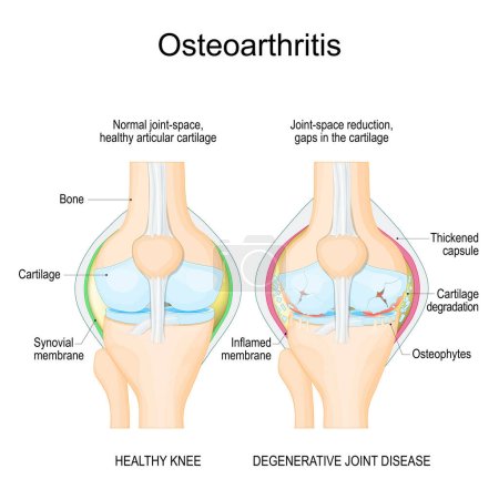 Arthrose. Gesunde Knie kommen hinzu, und Arthritis. degenerative Gelenkerkrankungen. Vektorillustration