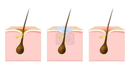 Illustration for Cleanse the pores and hair. Cross section of the human skin with keratotic plug, greasy hair or excessive sebum secretion. Washing skin with soap. Haired pore cleansing. Detoxify the pores on the facial skin. Vector illustration - Royalty Free Image