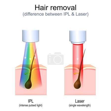 Haarentfernung. Laser gegen intensives gepulstes Licht (IPL). Vektordiagramm über den Zustand von Haut und Haaren während der Behandlung. Schönheitschirurgie. Schönheitswerbung. Realistische Illustration