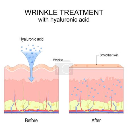 Wrinkle treatment with hyaluronic acid. Before and after procedure. Visible results. Smoother and Youthful skin. Poster for use in cosmetology, beauty, dermatology and aesthetic industry. Vector illustration