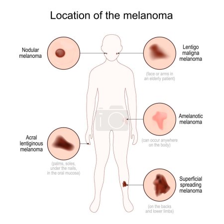 Location of the melanoma. Human body silhouette with Nodular, Acral lentiginous, Lentigo maligna, Superficial spreading and Amelanotic melanoma. Close-up of malignant skin cancer. Vector poster
