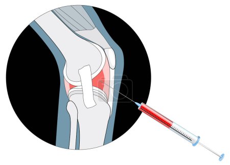 Illustration for Non-surgical treatments for arthritis. injections into the painful joint. Efficacy of Platelet-Rich Plasma Injections or PRP Therapy. Hyaluronic Acid, or Steroid and Cortisone Injection Procedure. Knee Osteoarthritis Treatment. Vector illustration - Royalty Free Image