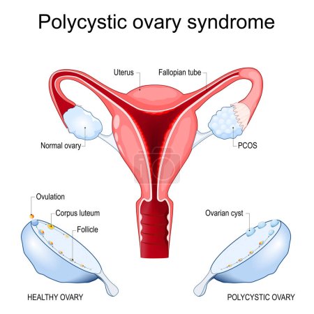 Síndrome de ovario poliquístico. Corte transversal de un útero con ovario normal y SOP. Primer plano del ovario después de la ovulación, con quiste, folículo y cuerpo lúteo. trastorno endocrino de las mujeres. Sistema reproductivo femenino. ilustración vectorial.