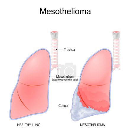 Ilustración de Mesotelioma. cáncer que se desarrolla a partir de la capa delgada de tejido pulmonar mesotelio. Tumor maligno causado por la exposición al amianto, la genética o la infección viral. Diferencias y comparaciones de un pulmón humano sano, y pulmón con mesotelioma. V. - Imagen libre de derechos
