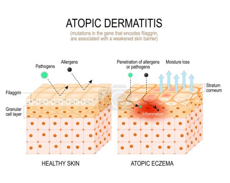 Illustration for Atopic dermatitis. Filaggrin theory and atopic eczema. mutations in the gene that encodes filaggrin, are associated with a weakened skin barrier. Close-up of cells of Stratum corneum with filament aggregating protein, and cross-section of skin - Royalty Free Image