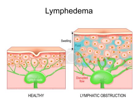 Lymphedema. Cross section of a human skin with healthy lymphatic vessel, and Swelling that caused of lymphoedema. Close-up of skin cells, and Lymph node with Disrupted flow, and and returns interstitial fluid to the bloodstream. Lymphatic obstruction