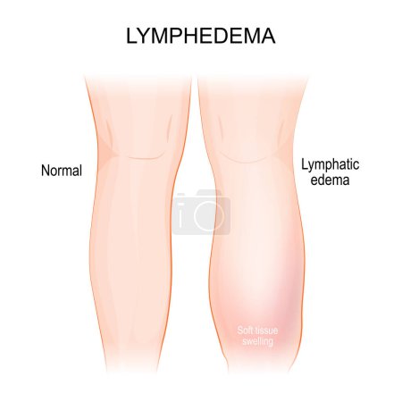 Illustration for Lymphedema. lymphoedema. Healthy leg, and lymphatic edema. swelling leg and foot that caused by a compromised lymphatic system. Part of human body. Vector illustration - Royalty Free Image