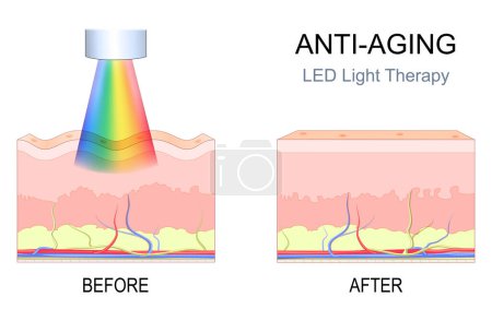 Illustration for Anti aging LED light therapy. Cross section human skin with wrinkles before procedure, and beautiful skin after rejuvenation therapy. face therapy in SPA resort. Vector illustration - Royalty Free Image
