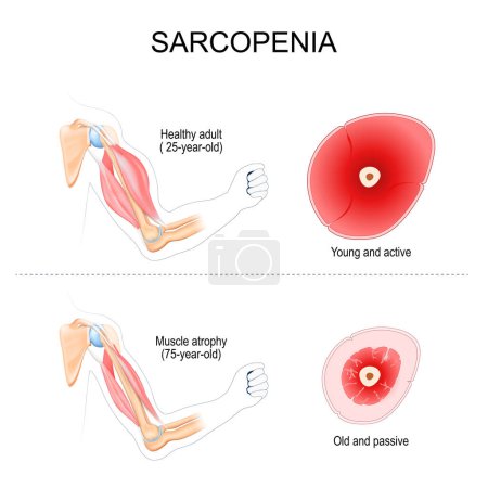 Illustration for Sarcopenia. Comparison and Difference between muscles of Healthy adult and arm with atrophy. Cross section of muscle of Young active person, and Old passive human. Vector illustration - Royalty Free Image