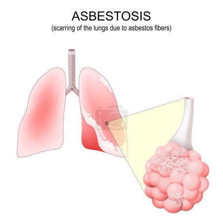 Téléchargez les illustrations : Asbestose. cicatrisant les poumons. Poumons humains avec plaque causée par l'amiante. Gros plan de l'alvéole avec des fibres d'amiante. Illustration vectorielle - en licence libre de droit