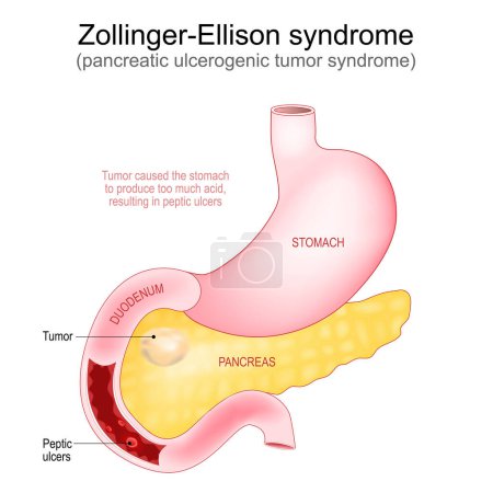 Illustration for Zollinger-Ellison syndrome. Gastrinoma is a tumor developed in the pancreas that caused of Peptic ulcers in Duodenum. Part of Human Digestive system. Vector illustration - Royalty Free Image