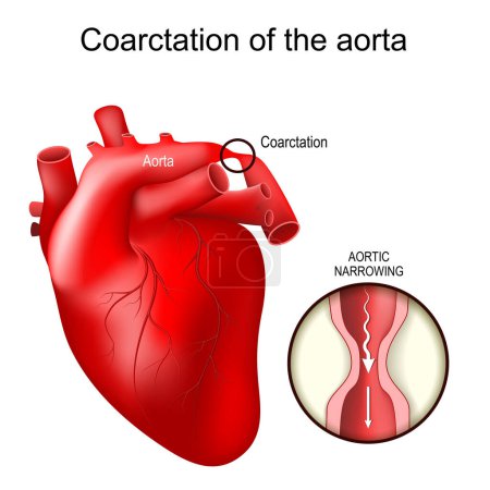 Téléchargez les illustrations : Coarctations aortiques. Déficience cardiaque congénitale. Gros plan de la section transversale du rétrécissement aortique. Anomalies cardiovasculaires. Sténose de l'aorte. illustration vectorielle - en licence libre de droit