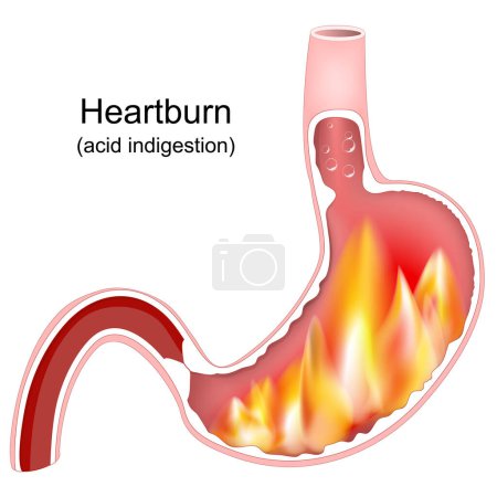 Illustrazione per Heartburn. Cross section of a stomach with flame. Pyrosis, cardialgia or acid indigestion. burning sensation in the stomach. Gastroesophageal reflux disease GERD. Vector illustration - Immagini Royalty Free