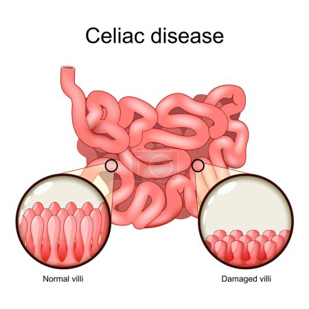 Illustration for Celiac disease. cross section of a small intestine with normal villi, and Damaged villi. Gluten intolerance. Autoimmune disorder and Gluten sensitivity. vector illustration - Royalty Free Image