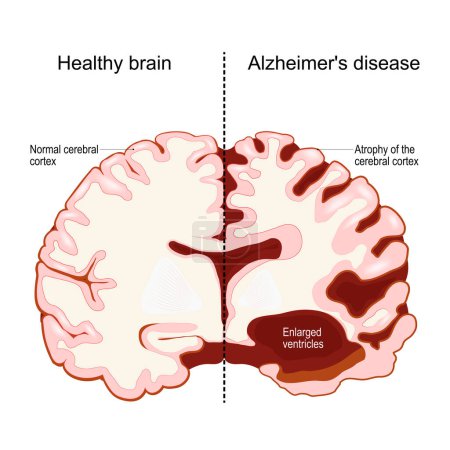 Téléchargez les illustrations : Cerveau humain, en deux moitiés : sain et la maladie d'Alzheimer. Trouble neurodégénératif. Démence. Perte de mémoire et déclin cognitif. Coupe transversale d'un hémisphère cérébral. Illustration vectorielle - en licence libre de droit