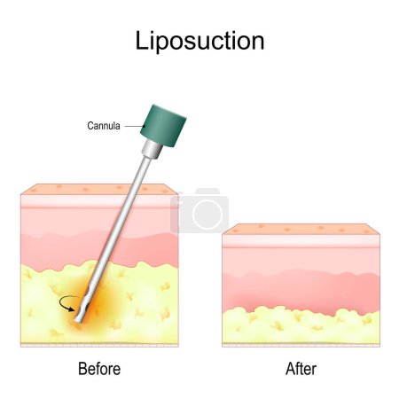 Illustration for Liposuction procedure. Before and after. Fat removal and Cosmetic surgery. Liposuction for weight loss. Vector illustration - Royalty Free Image