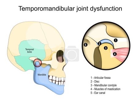 Illustration for Temporomandibular joint dysfunction syndrome. Side view of a Human skull with Temporal bone. Close-up of Muscles of mastication, and joint that connect the mandible to the skull. Vector illustration - Royalty Free Image