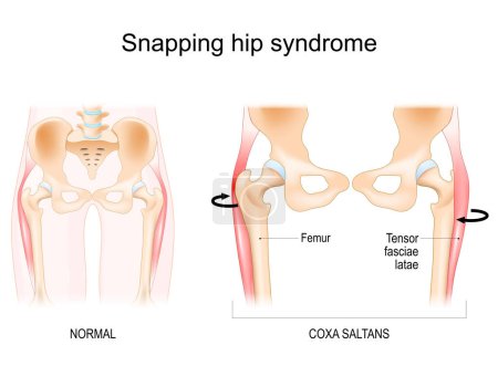 Snapping hip syndrome. Coxa saltans.  iliopsoas tendinitis. dancer's hip. Anatomy of a Human Hip. Vector illustration