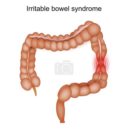 Illustration for Irritable Bowel Syndrome. IBS Symptoms. Gastrointestinal Disorders. Spastic colon. Vector illustration - Royalty Free Image
